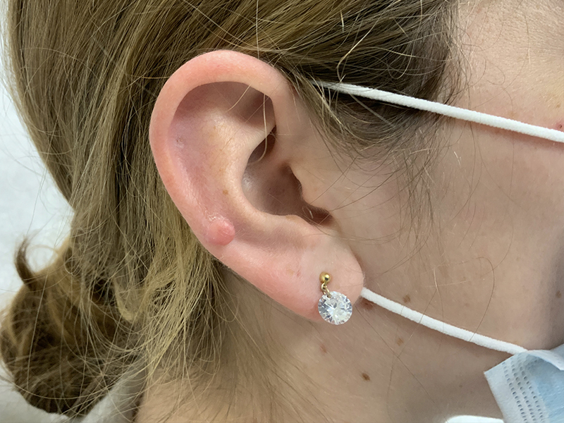 Keloid Removal Before and After | Montilla Plastic Surgery