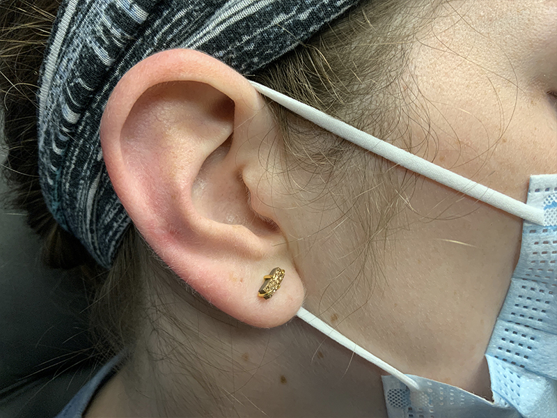 Keloid Removal Before and After | Montilla Plastic Surgery