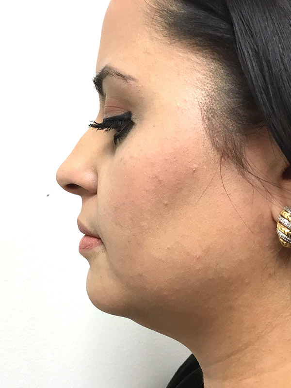 Kybella Before and After | Montilla Plastic Surgery 