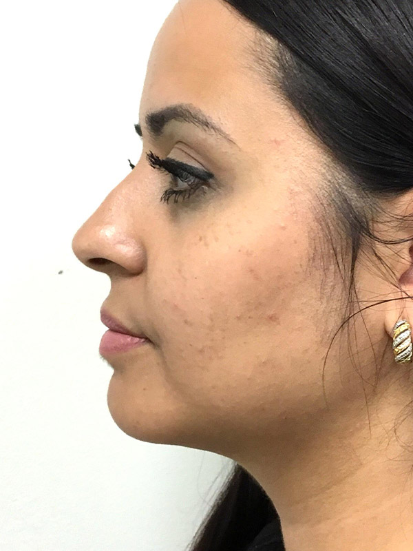 Kybella Before and After | Montilla Plastic Surgery 
