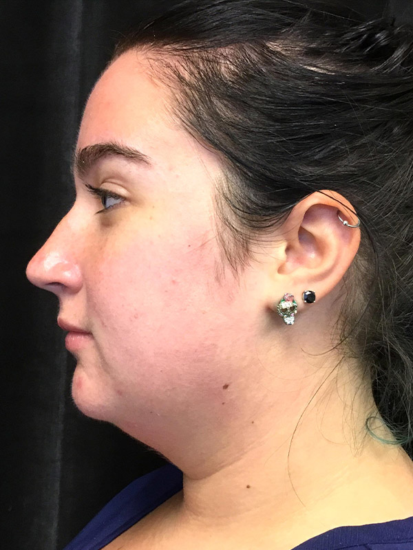 Kybella Before and After | Montilla Plastic Surgery 