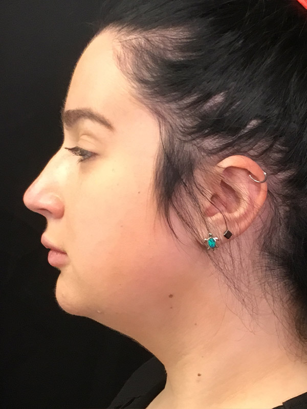 Kybella Before and After | Montilla Plastic Surgery 
