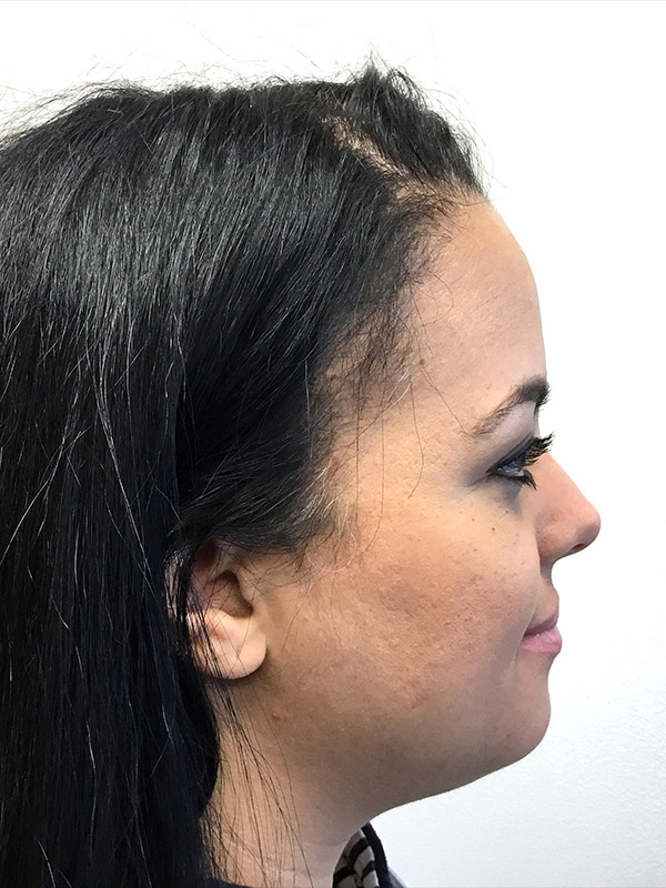 Kybella Before and After | Montilla Plastic Surgery 