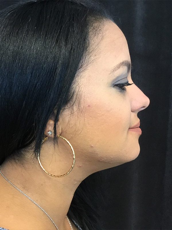 Kybella Before and After | Montilla Plastic Surgery 