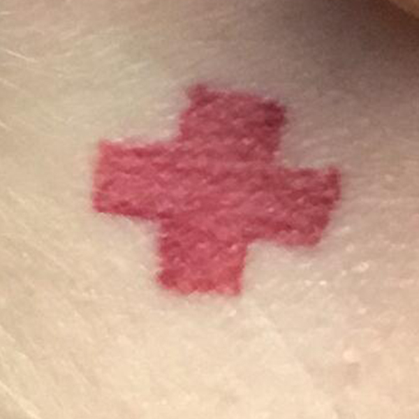 Laser Tattoo Removal Before and After | Montilla Plastic Surgery 