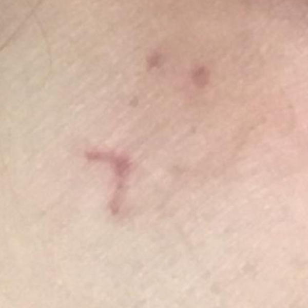Laser Tattoo Removal Before and After | Montilla Plastic Surgery 
