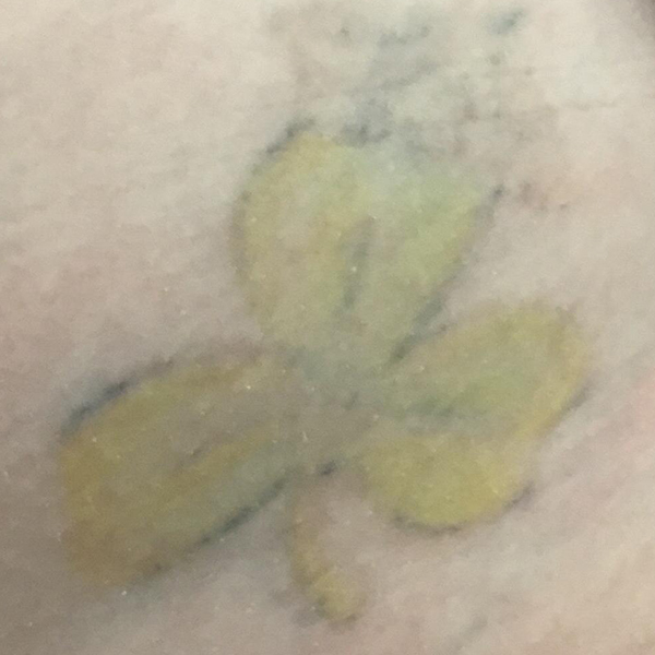 Laser Tattoo Removal Before and After | Montilla Plastic Surgery 