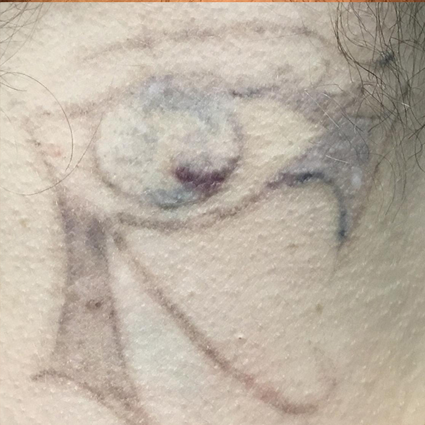Laser Tattoo Removal Before and After | Montilla Plastic Surgery 