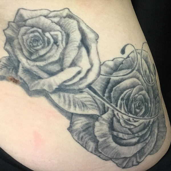 Laser Tattoo Removal Before and After | Montilla Plastic Surgery 