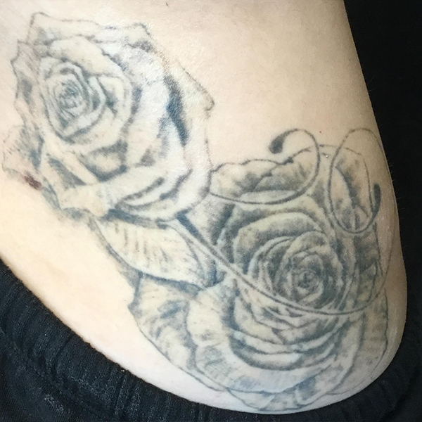 Laser Tattoo Removal Before and After | Montilla Plastic Surgery 