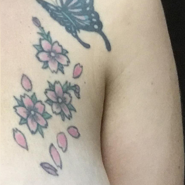 Laser Tattoo Removal Before and After | Montilla Plastic Surgery 