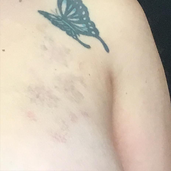 Laser Tattoo Removal Before and After 05 | Montilla Plastic Surgery Laser Tattoo Removal Before and After 05 | Montilla Plastic Surgery