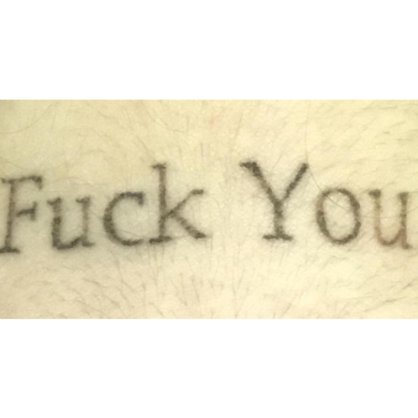 Laser Tattoo Removal Before and After | Montilla Plastic Surgery 