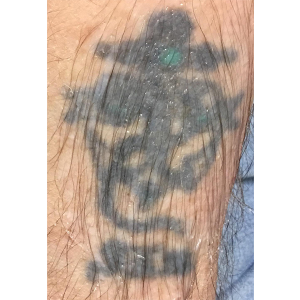 Laser Tattoo Removal Before and After | Montilla Plastic Surgery 