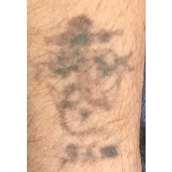 Laser Tattoo Removal Before and After | Montilla Plastic Surgery 