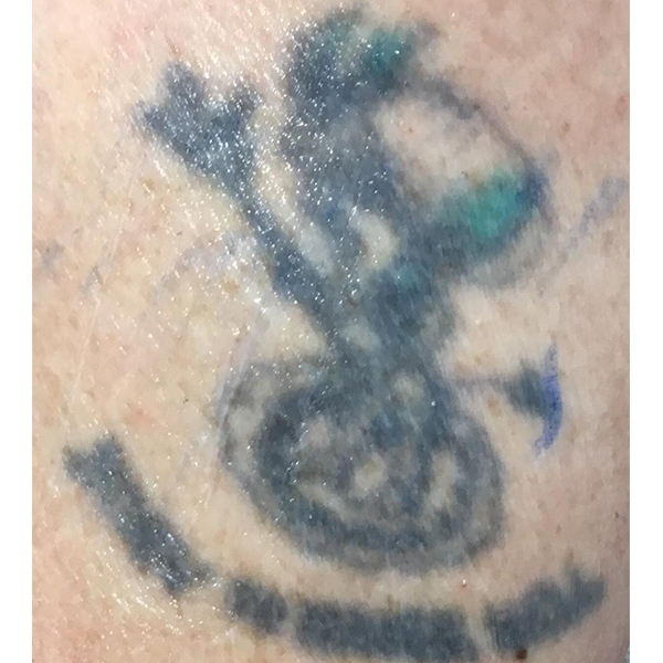 Laser Tattoo Removal Before and After 08 | Montilla Plastic Surgery Laser Tattoo Removal Before and After 08 | Montilla Plastic Surgery