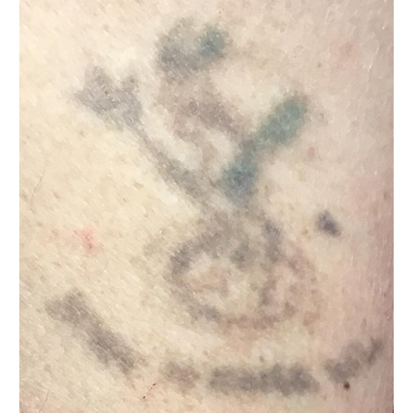 Laser Tattoo Removal Before and After | Montilla Plastic Surgery 