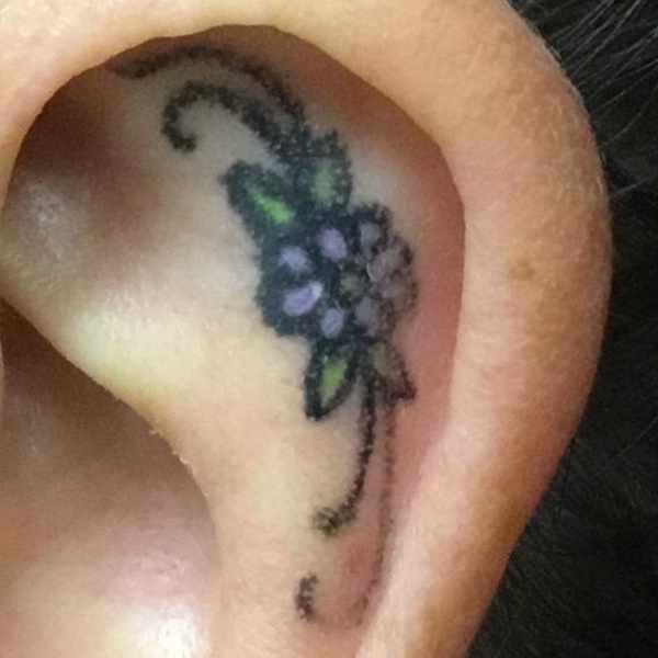 Laser Tattoo Removal Before and After | Montilla Plastic Surgery 