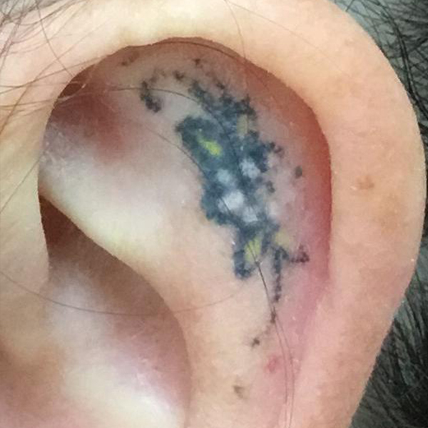 Laser Tattoo Removal Before and After | Montilla Plastic Surgery 