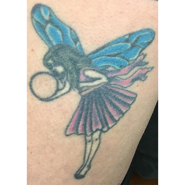 Laser Tattoo Removal Before and After | Montilla Plastic Surgery 