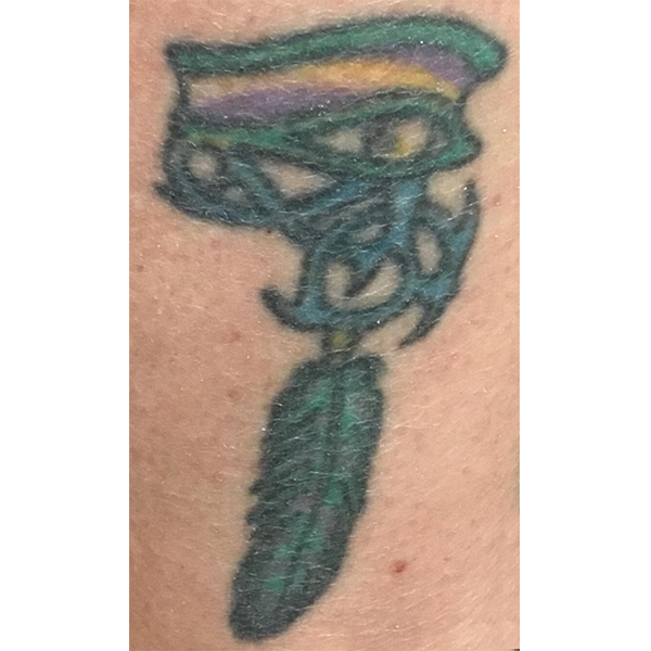 Laser Tattoo Removal Before and After | Montilla Plastic Surgery 
