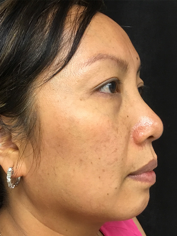 Laser Treatment Before and After | Montilla Plastic Surgery