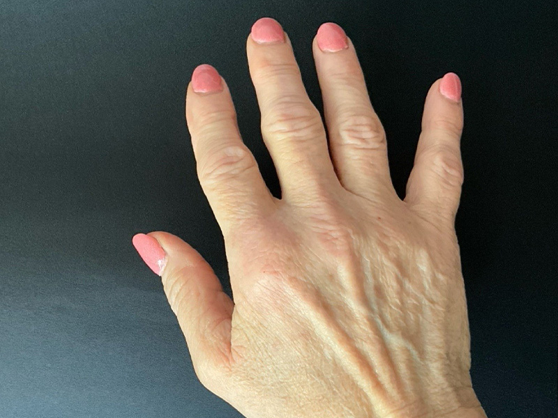 Laser Treatment Before and After | Montilla Plastic Surgery