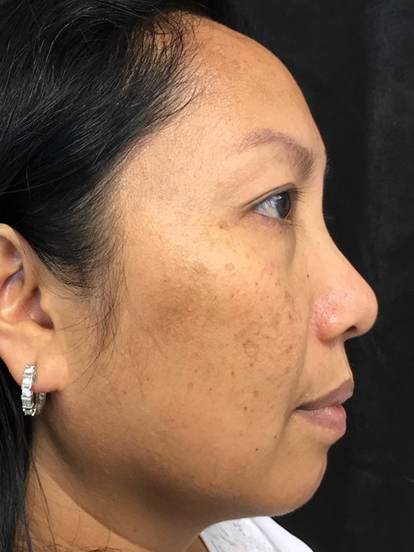 Laser Treatment Before and After | Montilla Plastic Surgery