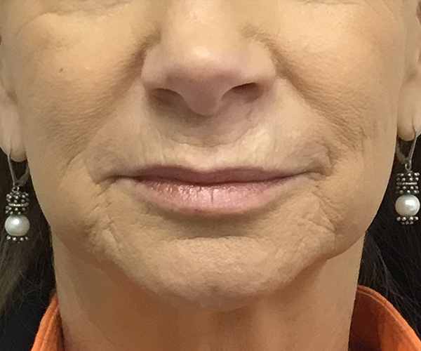 Lip Fillers Before and After | Montilla Plastic Surgery 