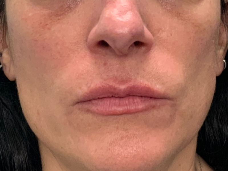 Lip Fillers Before and After | Montilla Plastic Surgery 