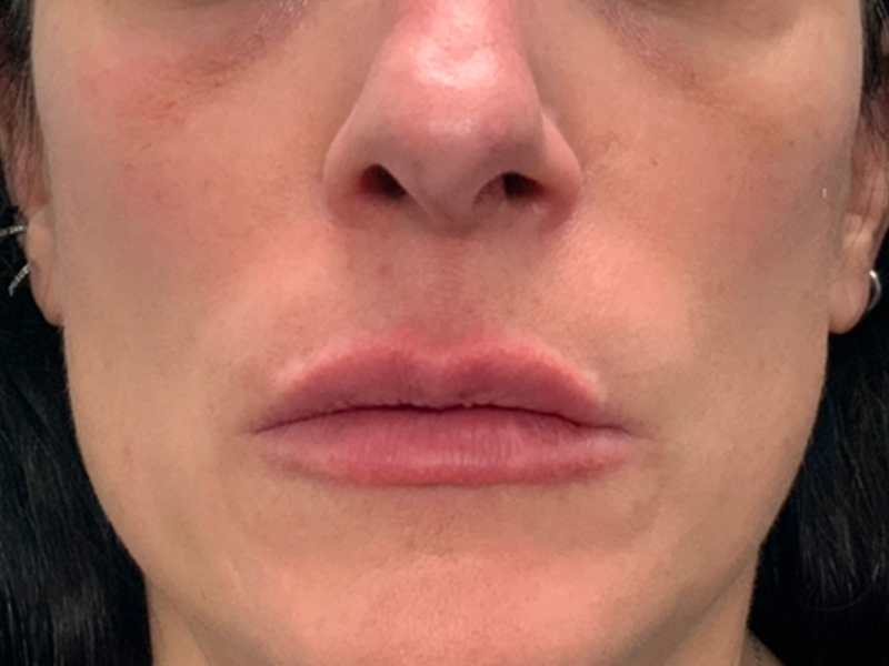 Lip Fillers Before and After | Montilla Plastic Surgery 