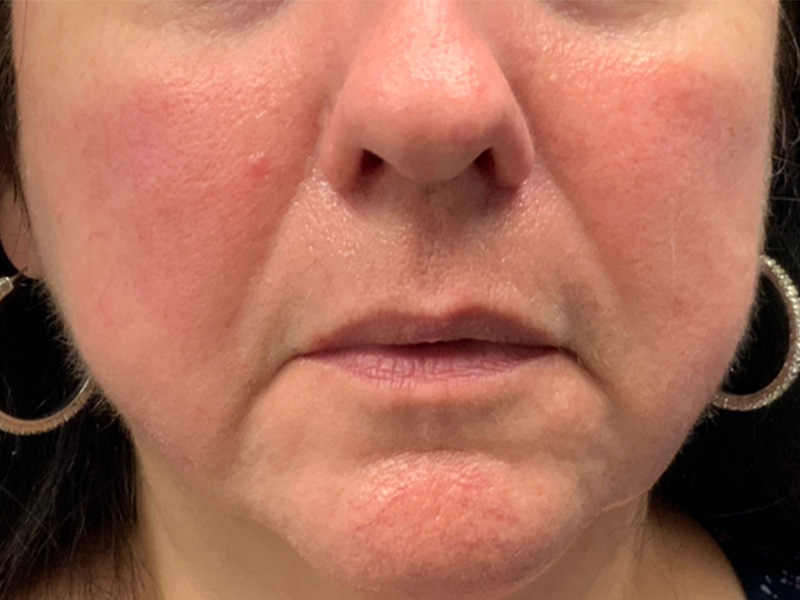 Lip Fillers Before and After | Montilla Plastic Surgery 