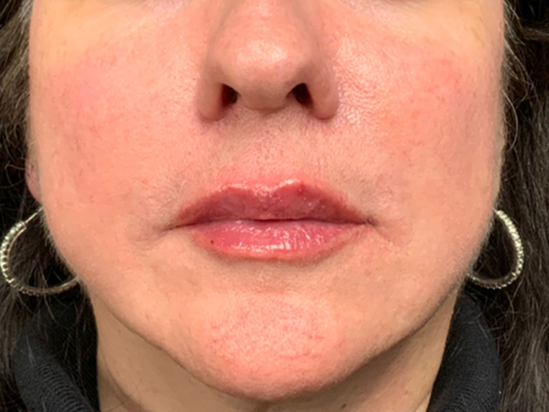 Lip Fillers Before and After | Montilla Plastic Surgery 