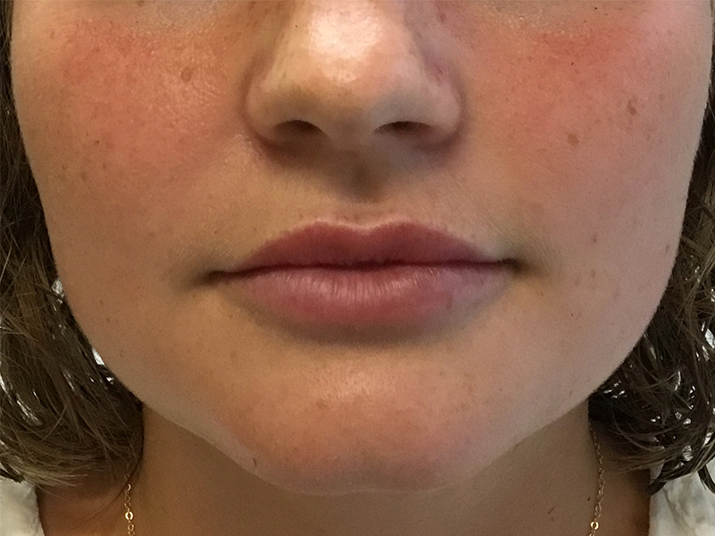 Lip Fillers Before and After | Montilla Plastic Surgery 