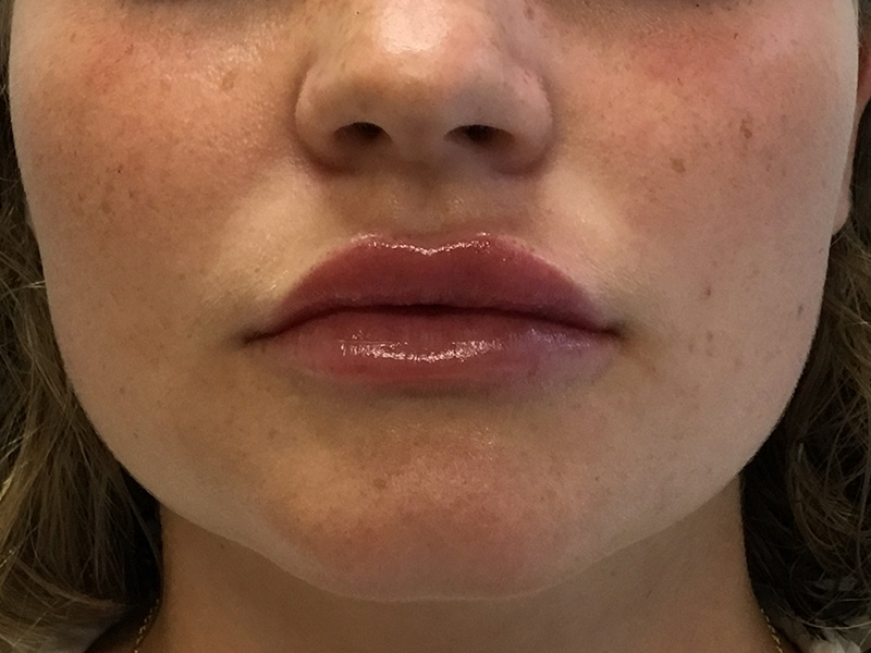 Lip Fillers Before and After | Montilla Plastic Surgery 