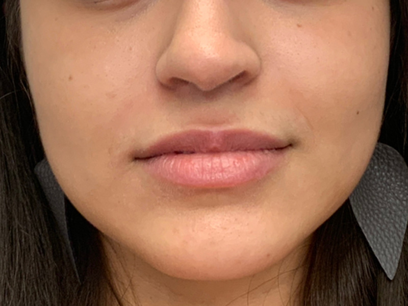 Lip Fillers Before and After | Montilla Plastic Surgery 