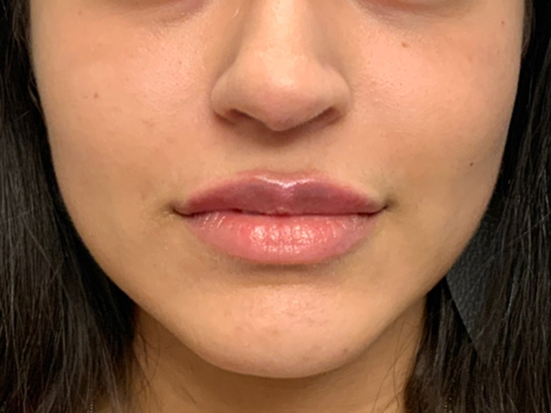 Lip Fillers Before and After | Montilla Plastic Surgery 