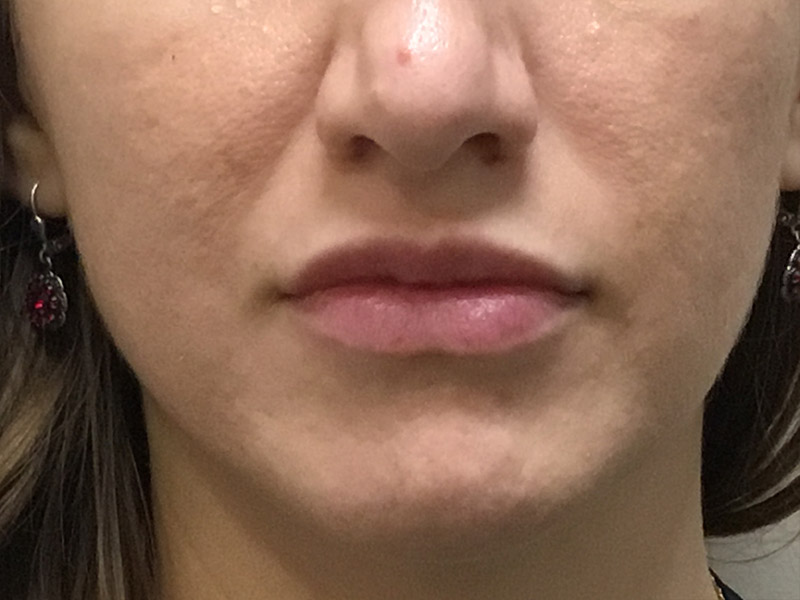 Lip Fillers Before and After | Montilla Plastic Surgery 