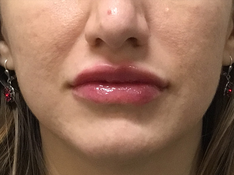 Lip Fillers Before and After | Montilla Plastic Surgery 
