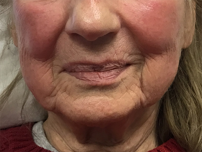 Lip Fillers Before and After | Montilla Plastic Surgery 