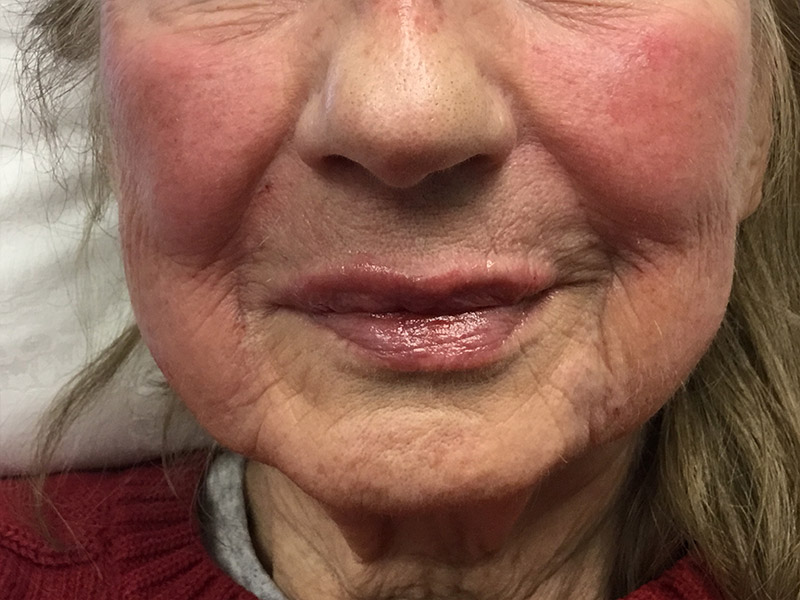Lip Fillers Before and After | Montilla Plastic Surgery 
