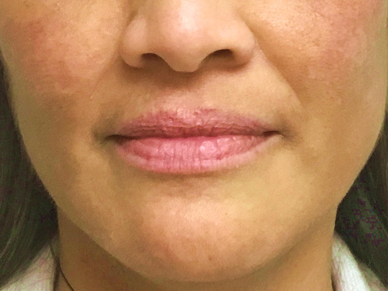 Lip Fillers Before and After | Montilla Plastic Surgery 