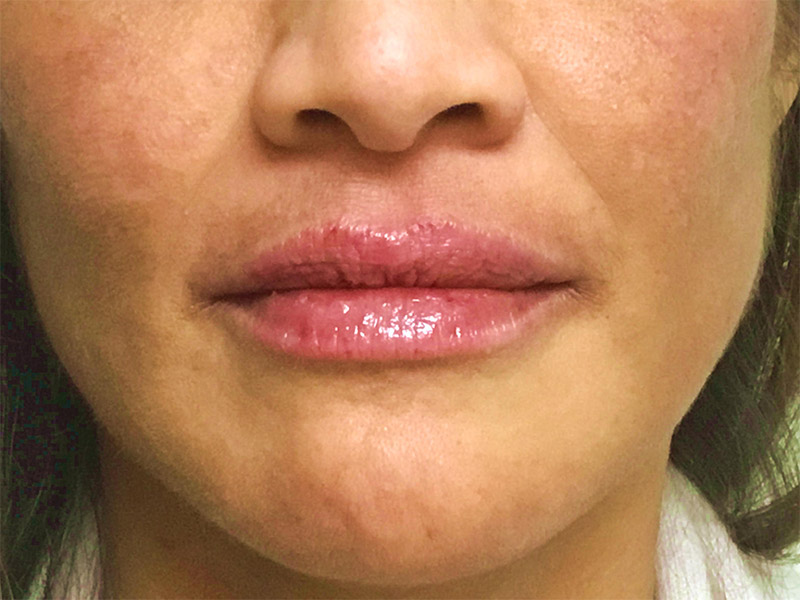 Lip Fillers Before and After | Montilla Plastic Surgery 