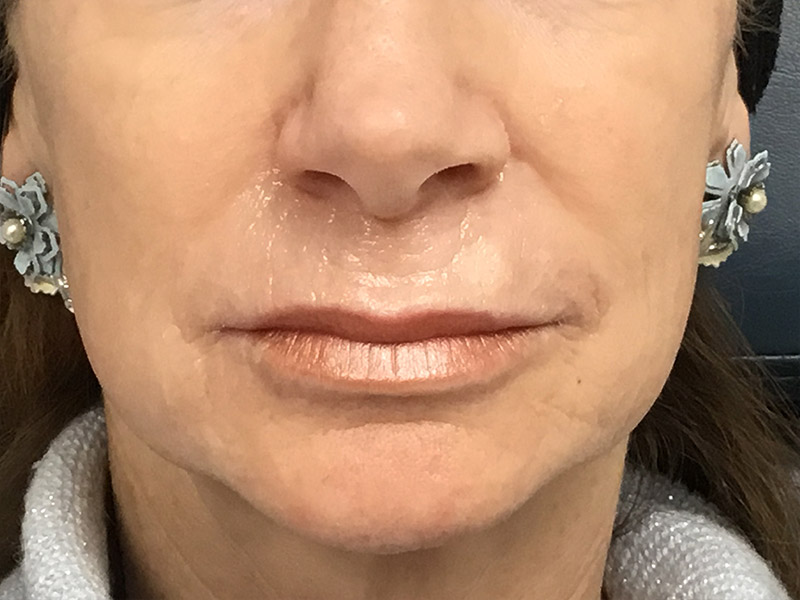 Lip Fillers Before and After | Montilla Plastic Surgery 