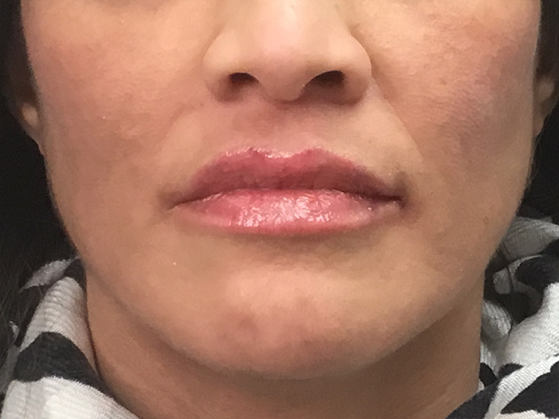 Lip Fillers Before and After | Montilla Plastic Surgery 
