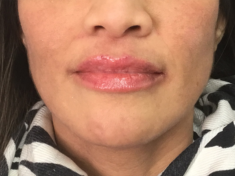 Lip Fillers Before and After | Montilla Plastic Surgery 