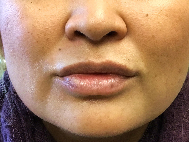 Lip Fillers Before and After | Montilla Plastic Surgery 