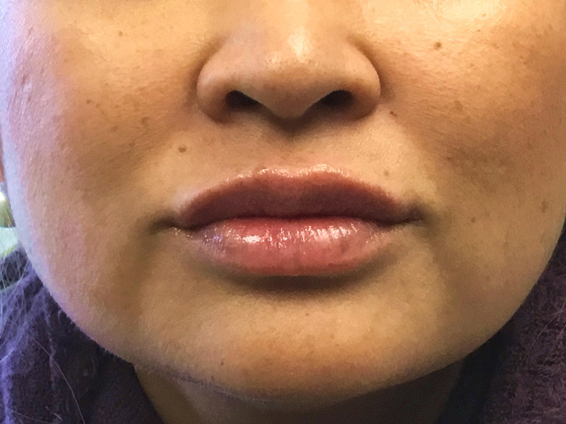 Lip Fillers Before and After | Montilla Plastic Surgery 
