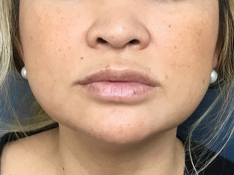 Lip Fillers Before and After | Montilla Plastic Surgery 