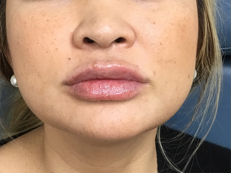 Lip Fillers Before and After | Montilla Plastic Surgery 